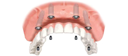 οδοντιατρος αθηνα